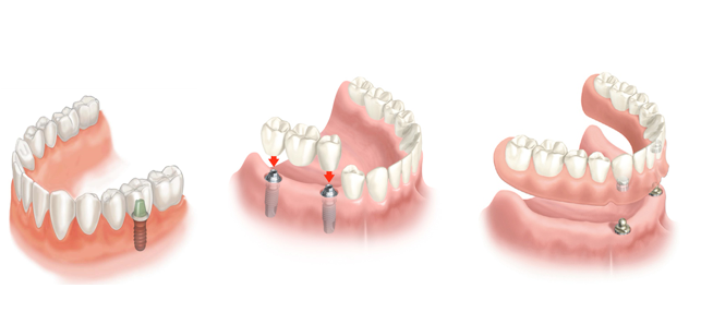 Tom Audreath Correlaat Experiment Implantaten – Tandarts Van Eikema Hommes – Doorwerth